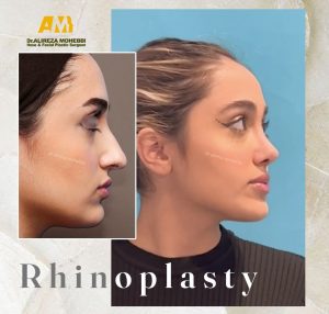 rhinoplasty - Dr. Mohebbi